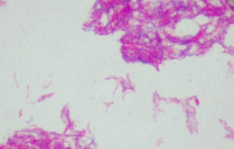 BCG vaccine